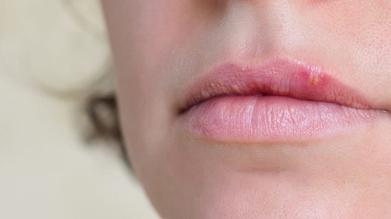 Close-up of female lips suffering from herpes